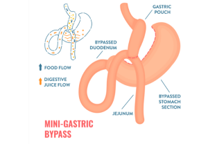 Mini-Gatric-Bypass Illustration