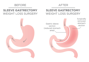 Gastric sleeve illustration